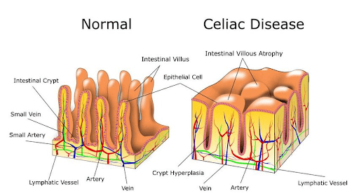 Intestinal villi normal compared to celiac diseased state
