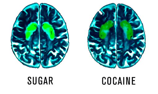 Scan of brain on sugar and cocaine