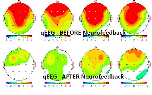 Neurofeedback EEG before and after