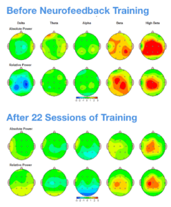 What Is Neurofeedback Therapy And Brain Training? | D'Connect