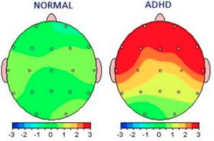 Normal brain and ADHD brain
