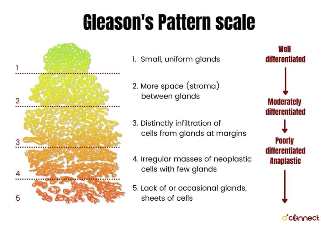 Gleason pattern scale