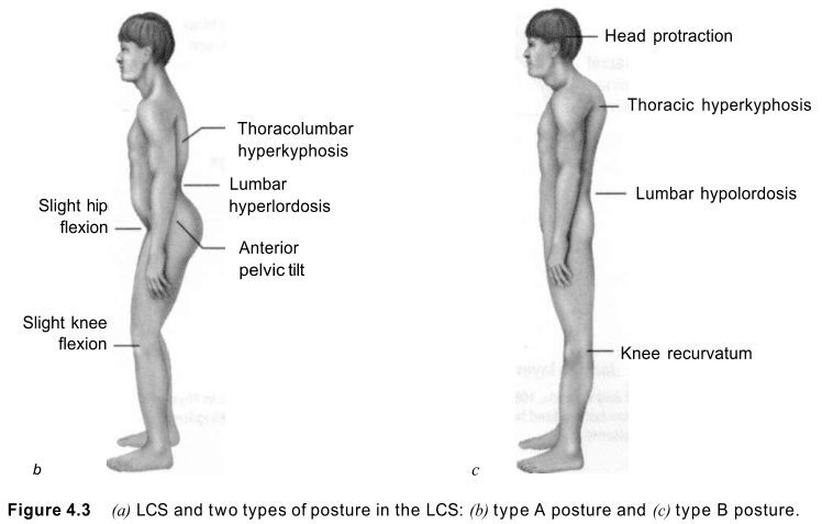 Lower Crossed Syndrome and Two types of Posture in LCS - Type A and Type B