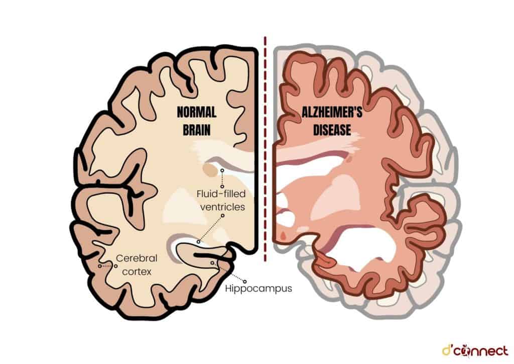Normal brain vs Alzheimer's brain