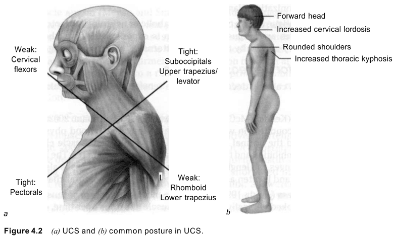Upper Crossed Syndrome and Common posture in upper crossed syndrome