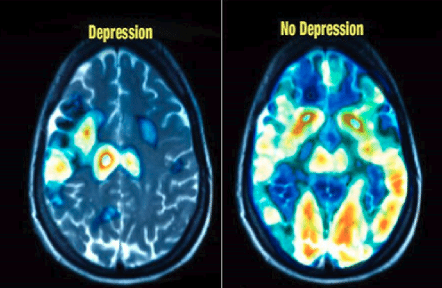Healthy and Depressed brain-min