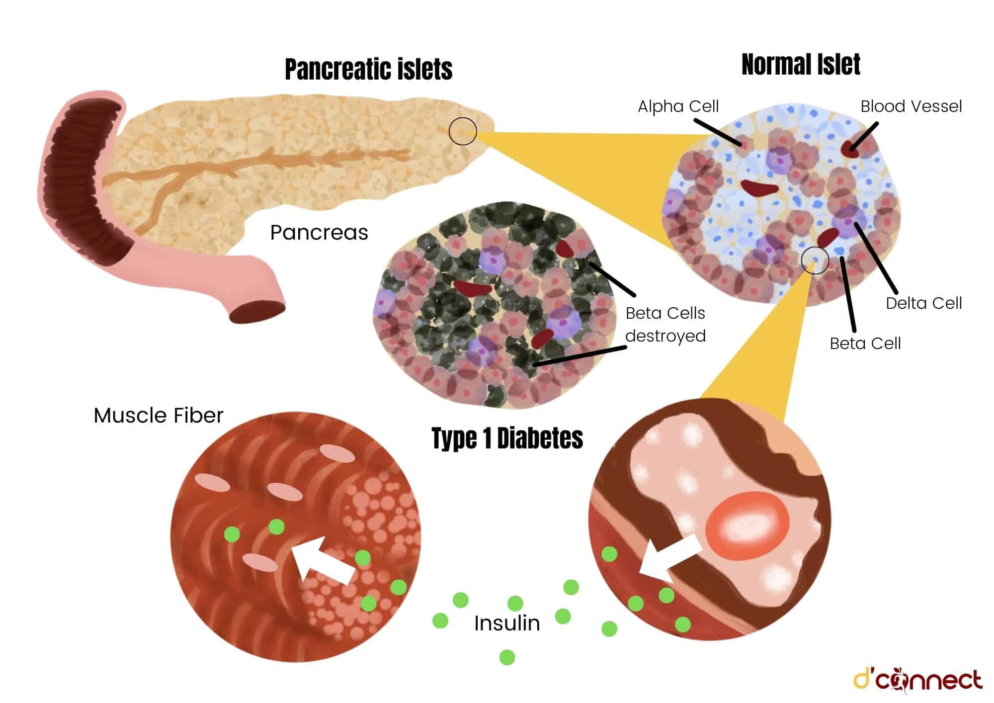 Diabetes — Early Signs, Causes, Types and Treatment | D'Connect