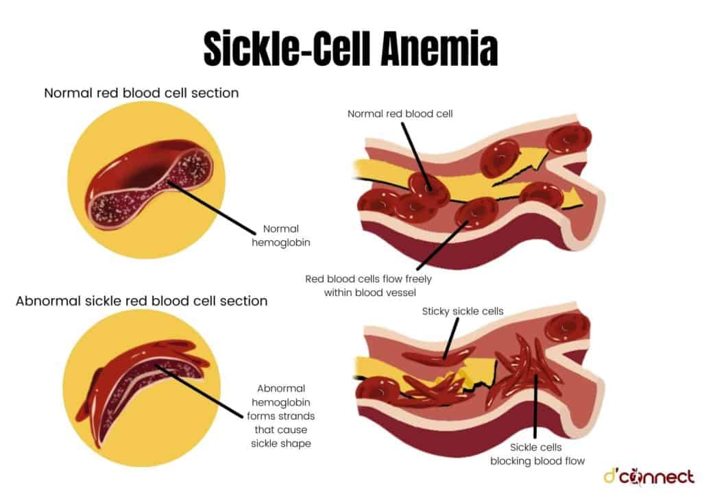 Zinc, blood and sickle cell anemia
