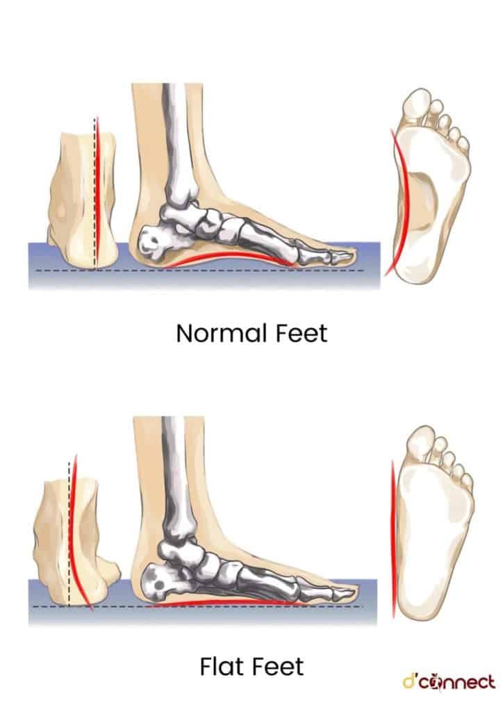 Normal and flat feet
