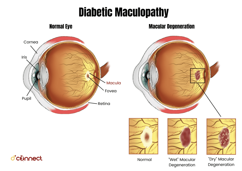 Diabetic maculopathy