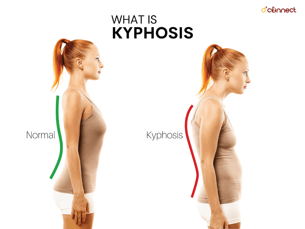 Posture, spine and Kyphosis