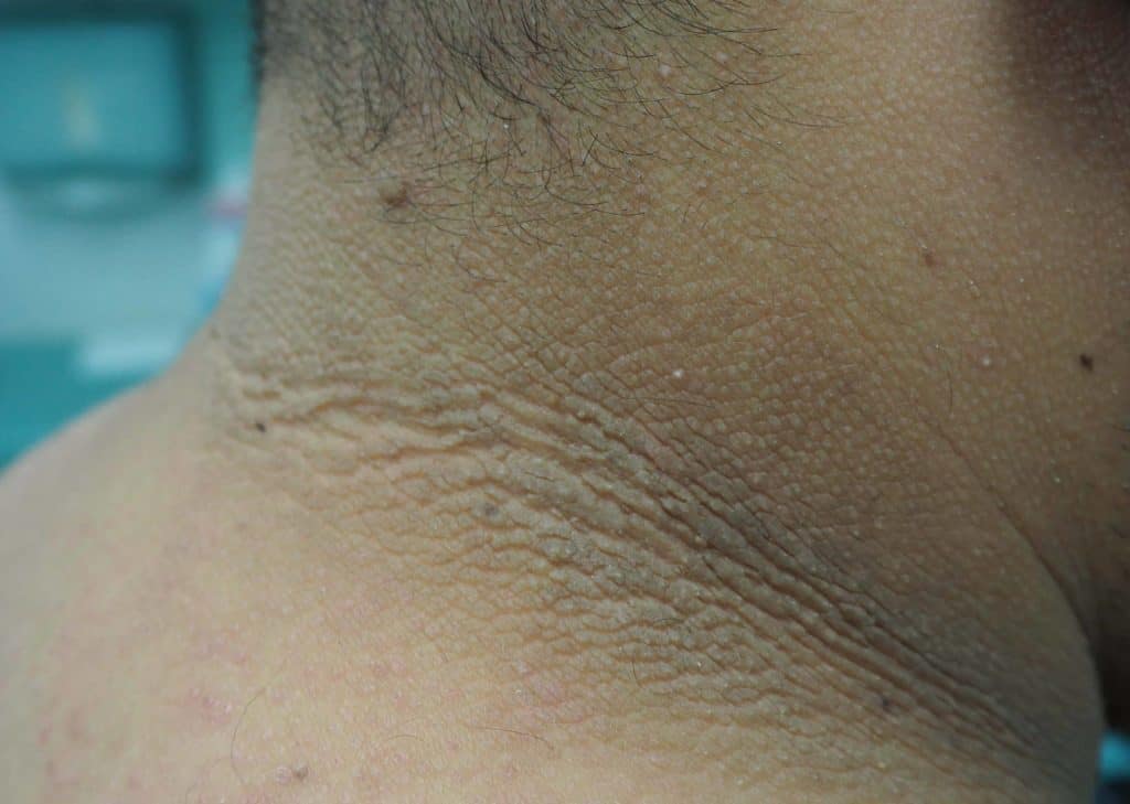 Acanthosis Nigricans and diabetes