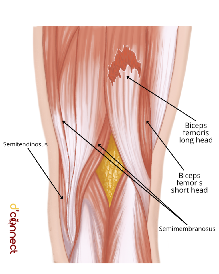 Leg Hamstring Atrophy Common issues with hamstring muscles (read before your next leg workout ...