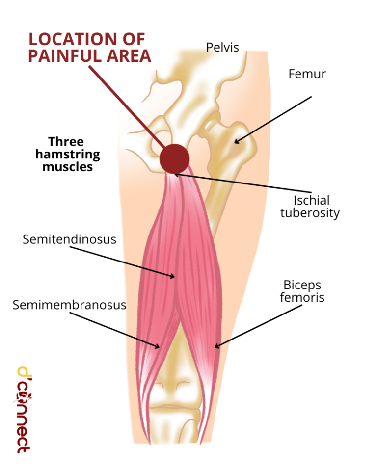 Leg Hamstring Atrophy Common issues with hamstring muscles (read before your next leg workout ...