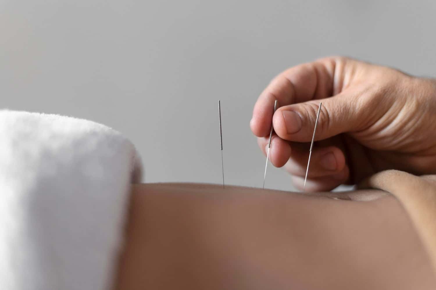 Imge of post Introduction to Acupuncture: History, Uses and Health Benefits