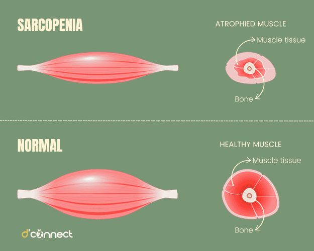 Muscles and sarcopenia