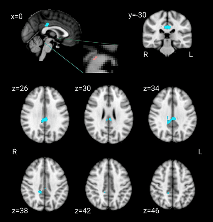 Connectivity with the dorsal raphé nucleus in older population with later life depression