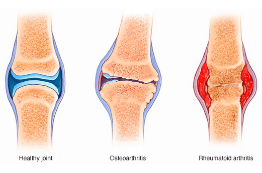 Osteoarthritis-vs.-rheumatoid-arthritis