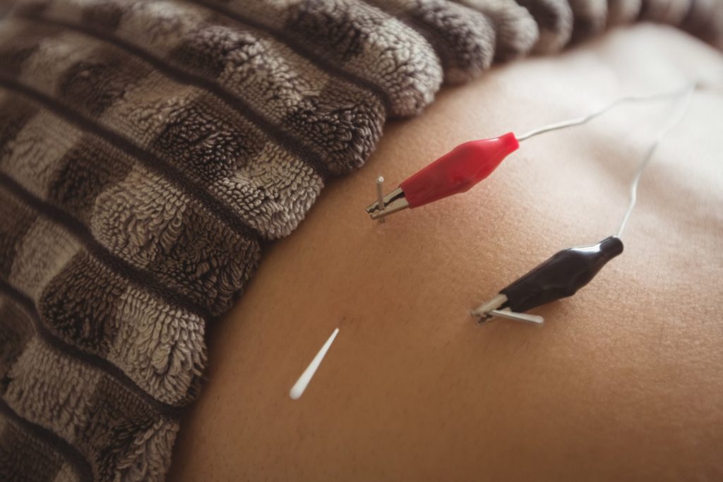 Electroacupuncture